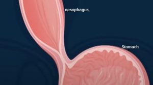 Peptic Ulcer, esophageal cancer