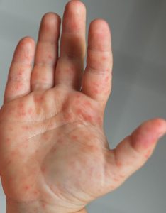 Hand, foot, and mouth disease (Coxsackie virus infection)