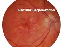 Wet Macular Degeneration Symptoms Treatment