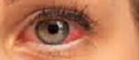 Conjuctivitis, pink eye SYMPTOMS CAUSES TREATMENT