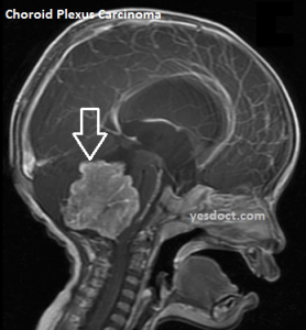 Choroid Plexus Carcinoma Symptoms  causes Treatment