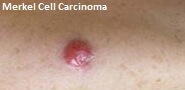 Merkel Cell Carcinoma, symptoms, treatment