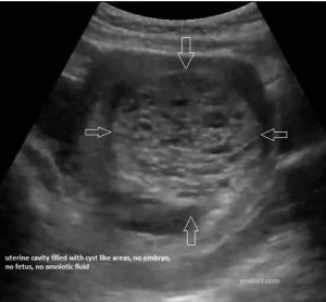 Molar pregnancy, stmptoms treatment