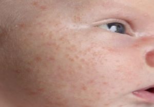 Baby acne symptoms Treatment