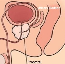 Prostate cancer symptoms causes treatment