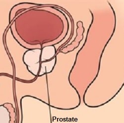 Benign prostatic hyperplasia (BPH) Symptoms Treatment