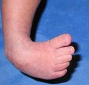 Clubfoot Symptoms Causes Treatment