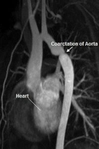 Coarctation of Aorta SYMPTOMS CAUSES TREATMENT