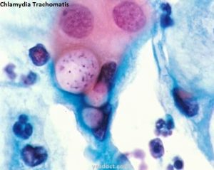Chlamydia Trachomatis Symptoms Causes Treatment