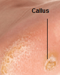 callus and corn causes symptoms treatment