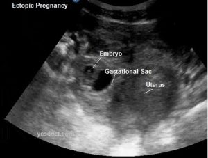 ECTOPIC PREGNANCY Symptoms Causes Treatment