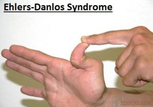Ehlers-Danlos Syndrome Causes Symptoms Treatment 