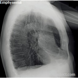 Emphysema Causes Symptoms Treatment 