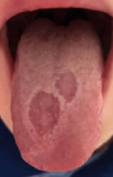 GEOGRAPHIC TONGUE SYMPTOMS CAUSES TREATMENT