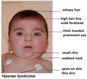 Noonan Syndrome SYMPTOMS CAUSES TREATMENT