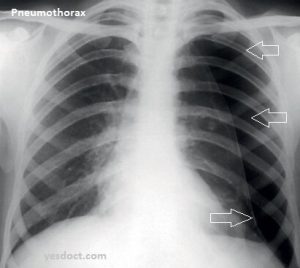 Pneumothorax Causes Symptoms Treatment 