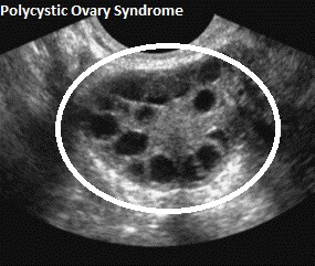 Polycystic Ovary Syndrome Symptoms Treatment
