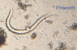 Pinworm Infection Symptoms Causes Treatment