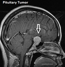 Pituitary Tumor Symptoms Causes Treatment