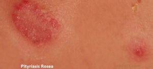 Pityriasis Rosea Symptoms Causes Treatment