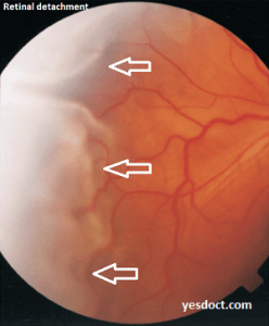 Retinal Detachment Symptoms Causes Treatment