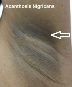 Acanthosis Nigrican Symptoms Causes Treatment