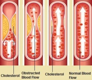 Atherosclerosis Symptoms Causes Treatment