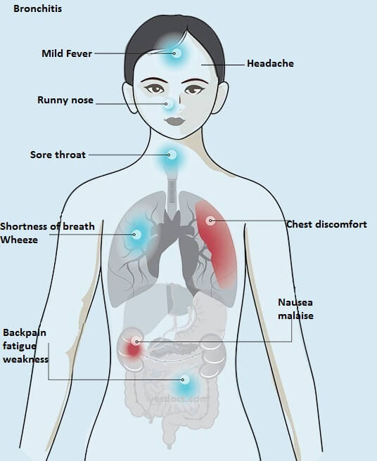 Bronchitis Symptoms Causes Treatment
