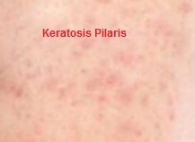 KERATOSIS PILARIS SYMPTOMS CAUSES TREATMENT