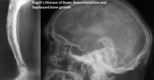 Pagets Disease of Bone causes treatment