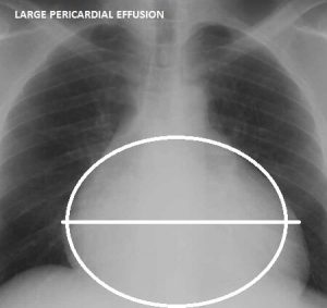 Pericardial Effusion Causes Symptoms Treatment 