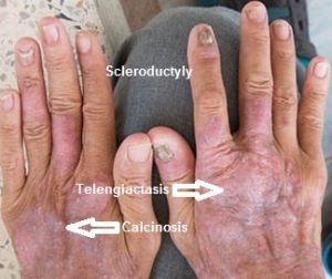 LIMITED SCLERODERMA  SYMPTOMS CAUSES TREATMENT