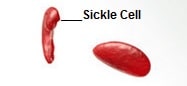 Sickle cell Disease Symptoms causes treatment