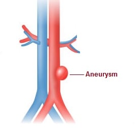 Aneurysm Symptoms Causes Treatment