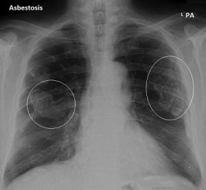Asbestosis Symptoms Causes Treatment