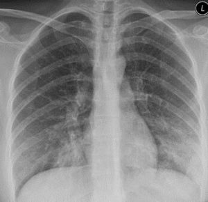 Pneumonia Symptoms Causes Treatment