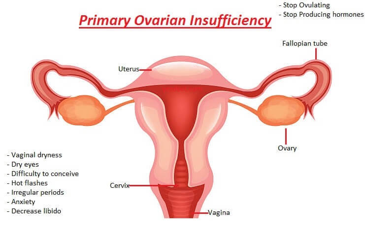 Primary Ovarian Insufficiency Symptoms Causes Treatment