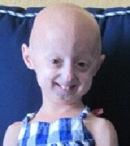 Progeria Symptoms Causes Treatment