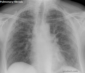Pulmonary Fibrosis Symptoms Causes Treatment