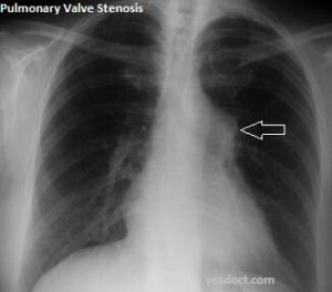 Pulmonary Valve Stenosis Symptoms Causes Treatment