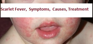 Scarlet Fever Symptoms Causes Treatment
