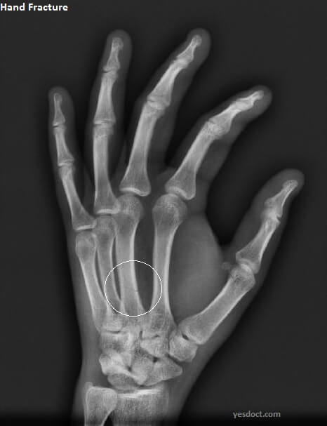 broken hand symptoms causes treatment