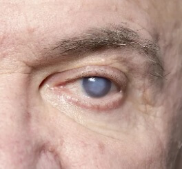 Cataract Symptoms Causes Treatment