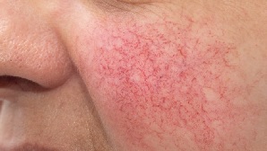 Rosacea Symptoms Causes Treatment